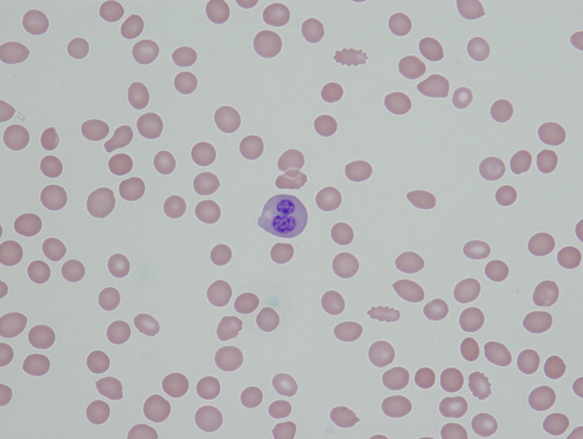 The peripheral blood smear shows circulating erythroid precursors with dyserythropoietic features. (Wright-Giemsa; 1000x magnification)